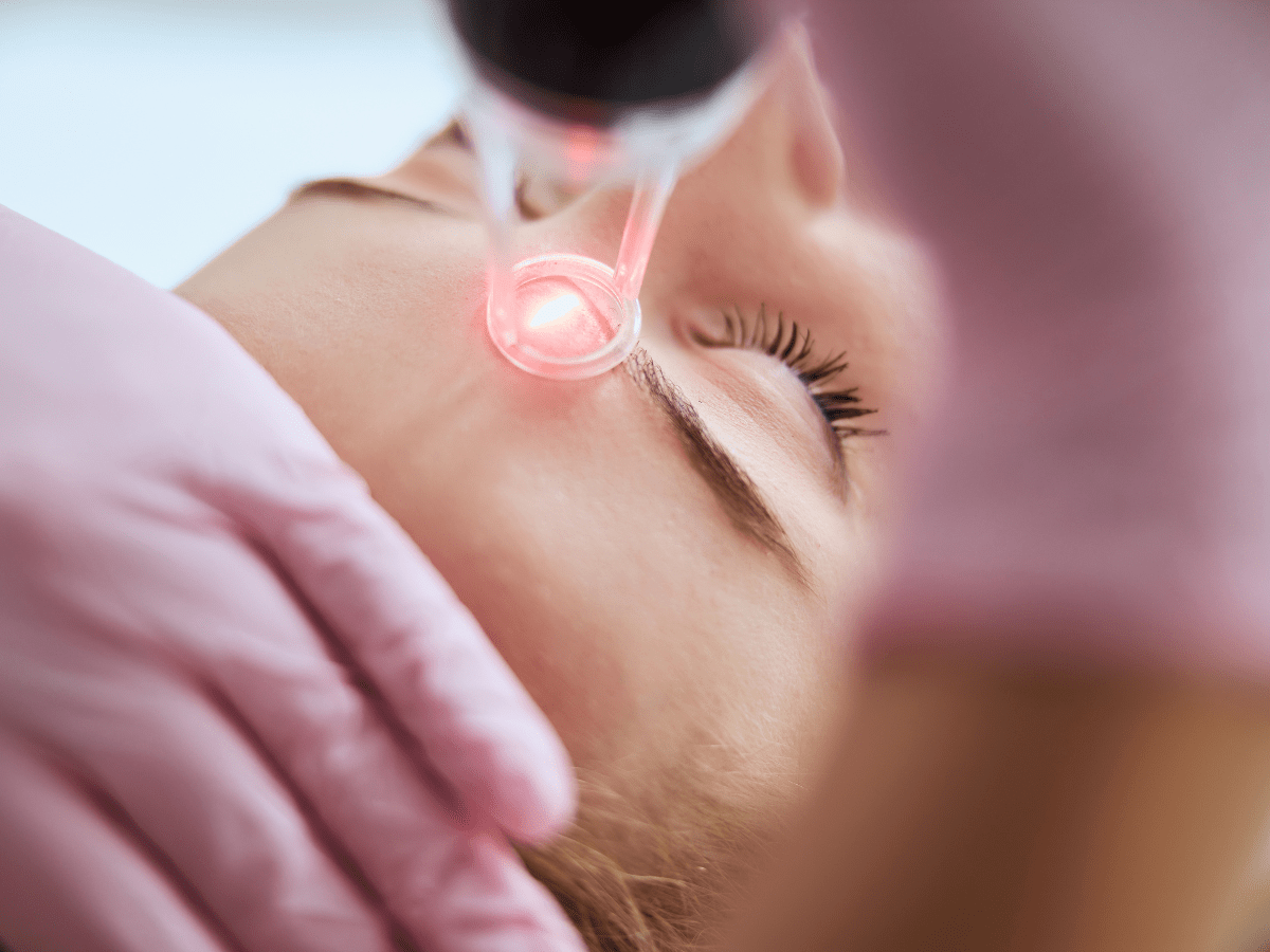 laser treatment on forehead